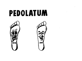 PEDOLATUM BEFORE AFTER