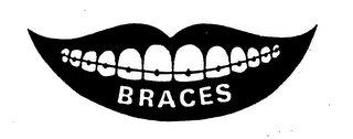 BRACES