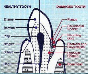 HEALTHY TOOTH DAMAGED TOOTH ENAMEL DENTINE PULP GINGIVA SULCUS ROOT PLAGUE PERIODONTAL POCKET RECEDING GUM BACTERIAL AND FOOD DEBRIS EXPOSED DENTINE BONE LOSS